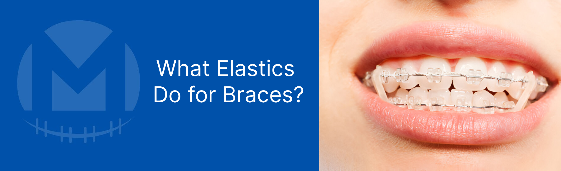 What Elastics Do for Braces? The Key to a Straighter Smile