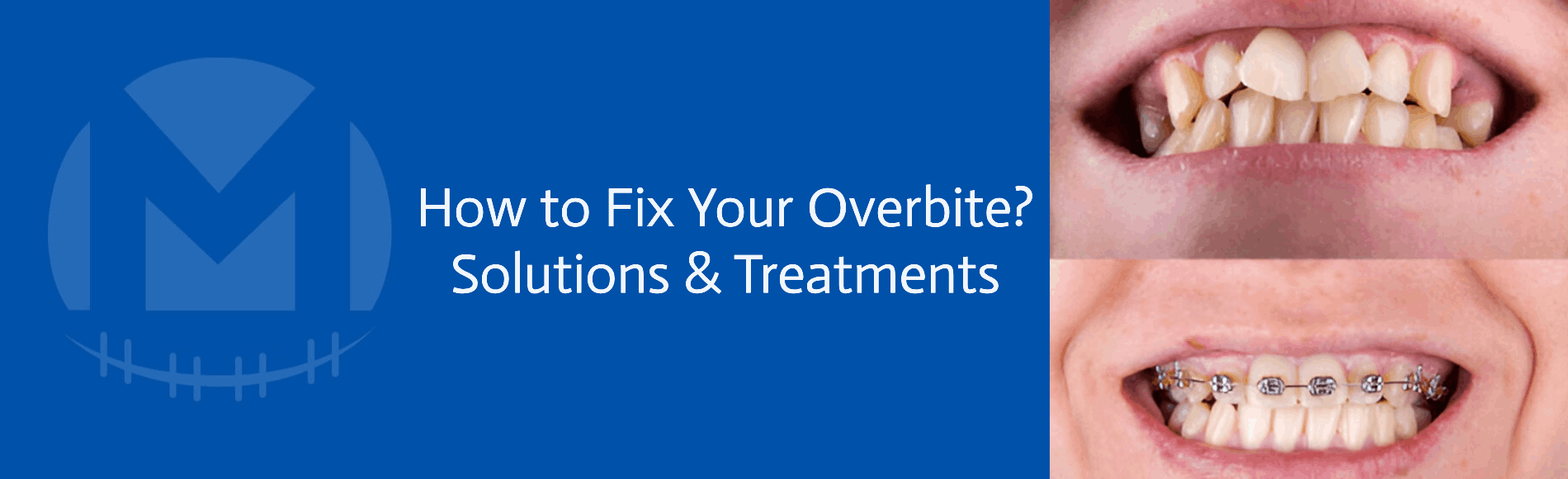 How to Fix Your Overbite: Solutions and Treatments